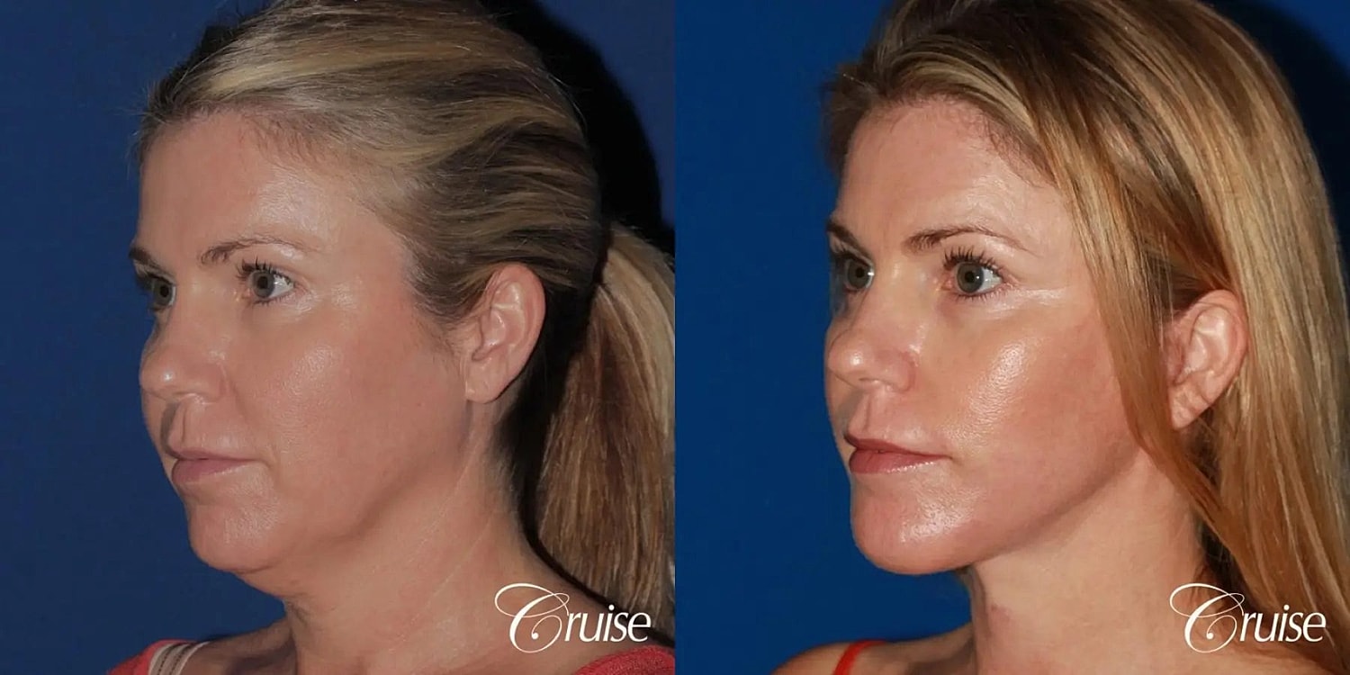 Chin Augmentation Before & After