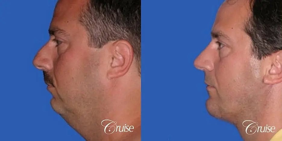 Chin Augmentation Before & After