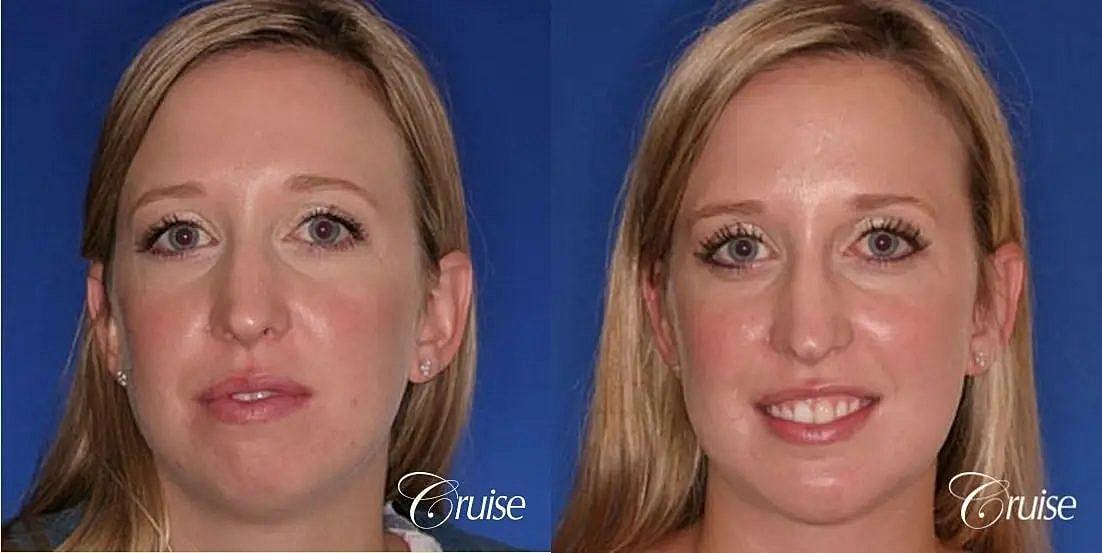 Chin Augmentation Before & After