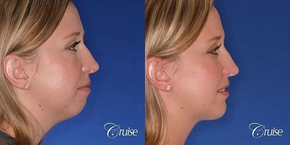 Chin Augmentation Before & After
