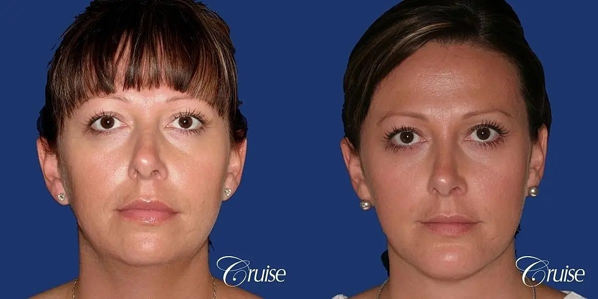 Chin Augmentation Before & After