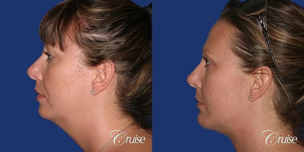 Chin Augmentation Before & After