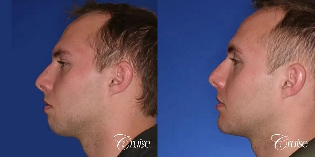 Chin Augmentation Before & After