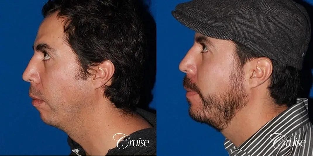 Chin Augmentation Before & After
