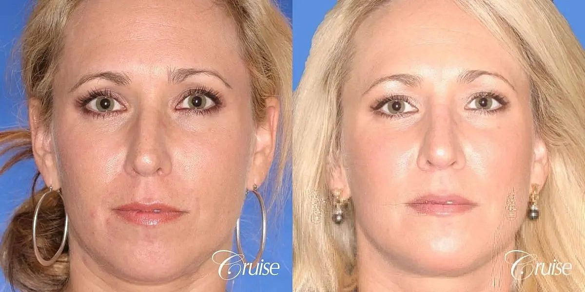 Chin Augmentation Before & After