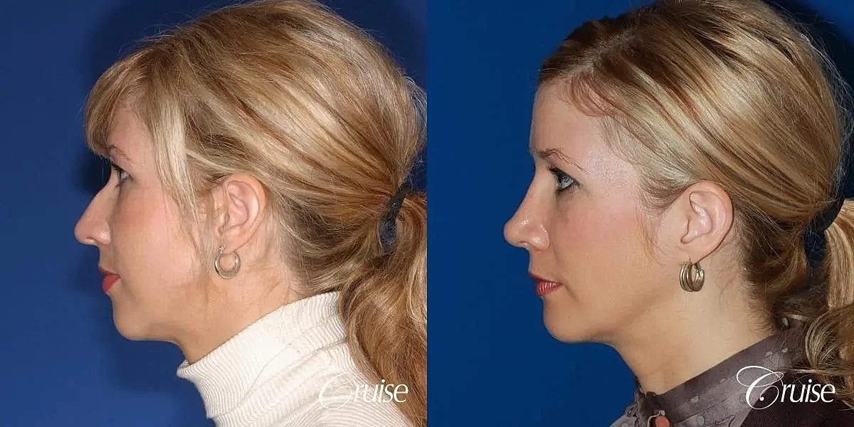 Chin Augmentation Before & After