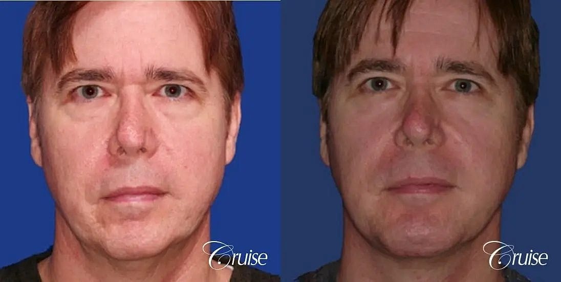 Chin Augmentation Before & After