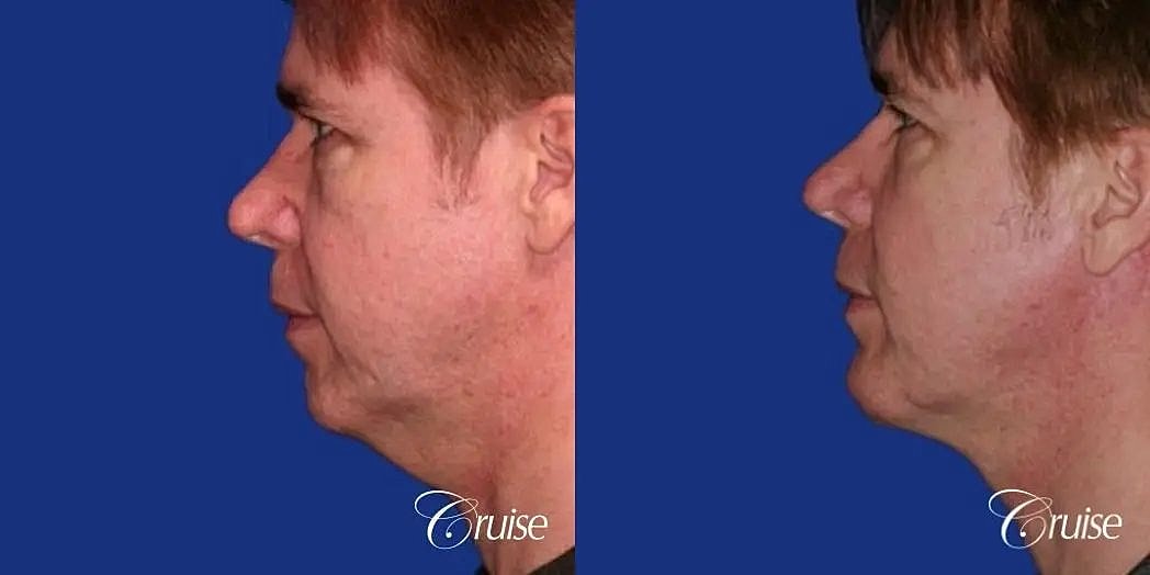 Chin Augmentation Before & After