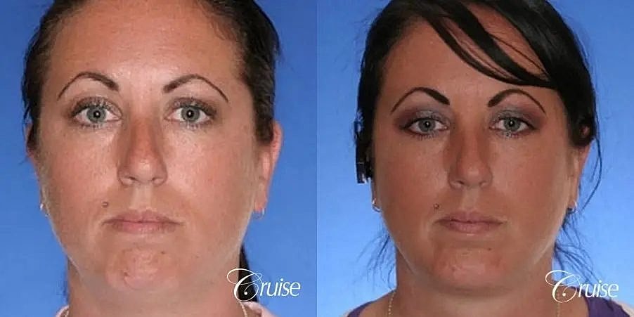 Chin Augmentation Before & After
