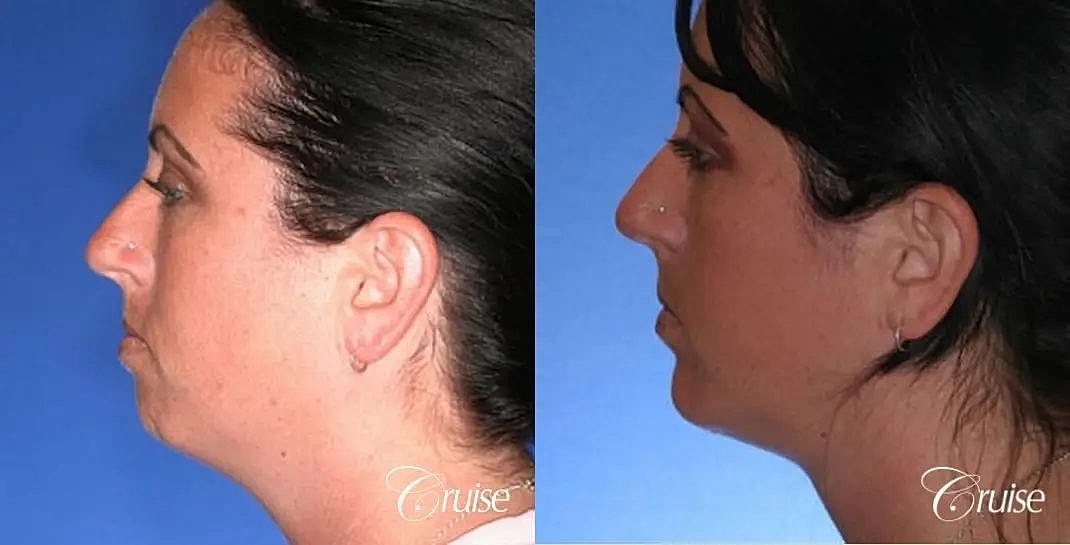 Chin Augmentation Before & After