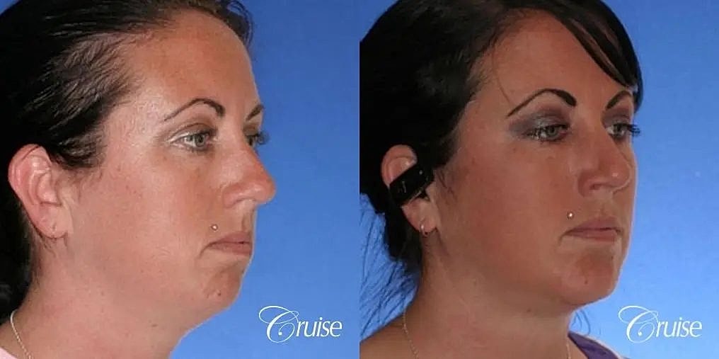 Chin Augmentation Before & After