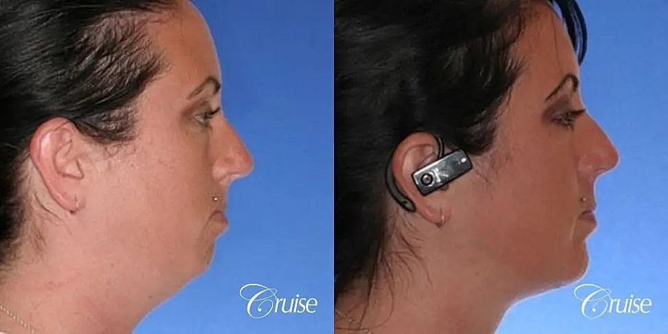 Chin Augmentation Before & After
