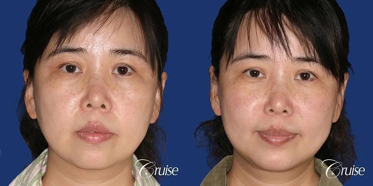 Chin Augmentation Before & After