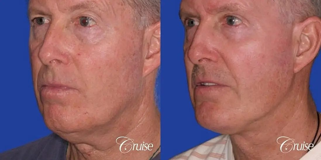 Chin Augmentation Before & After