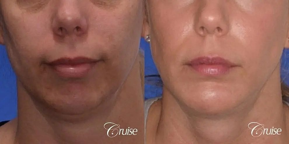 Chin Augmentation Before & After