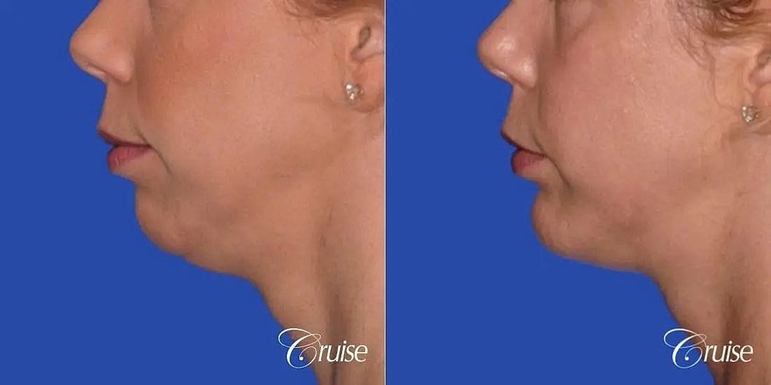 Chin Augmentation Before & After
