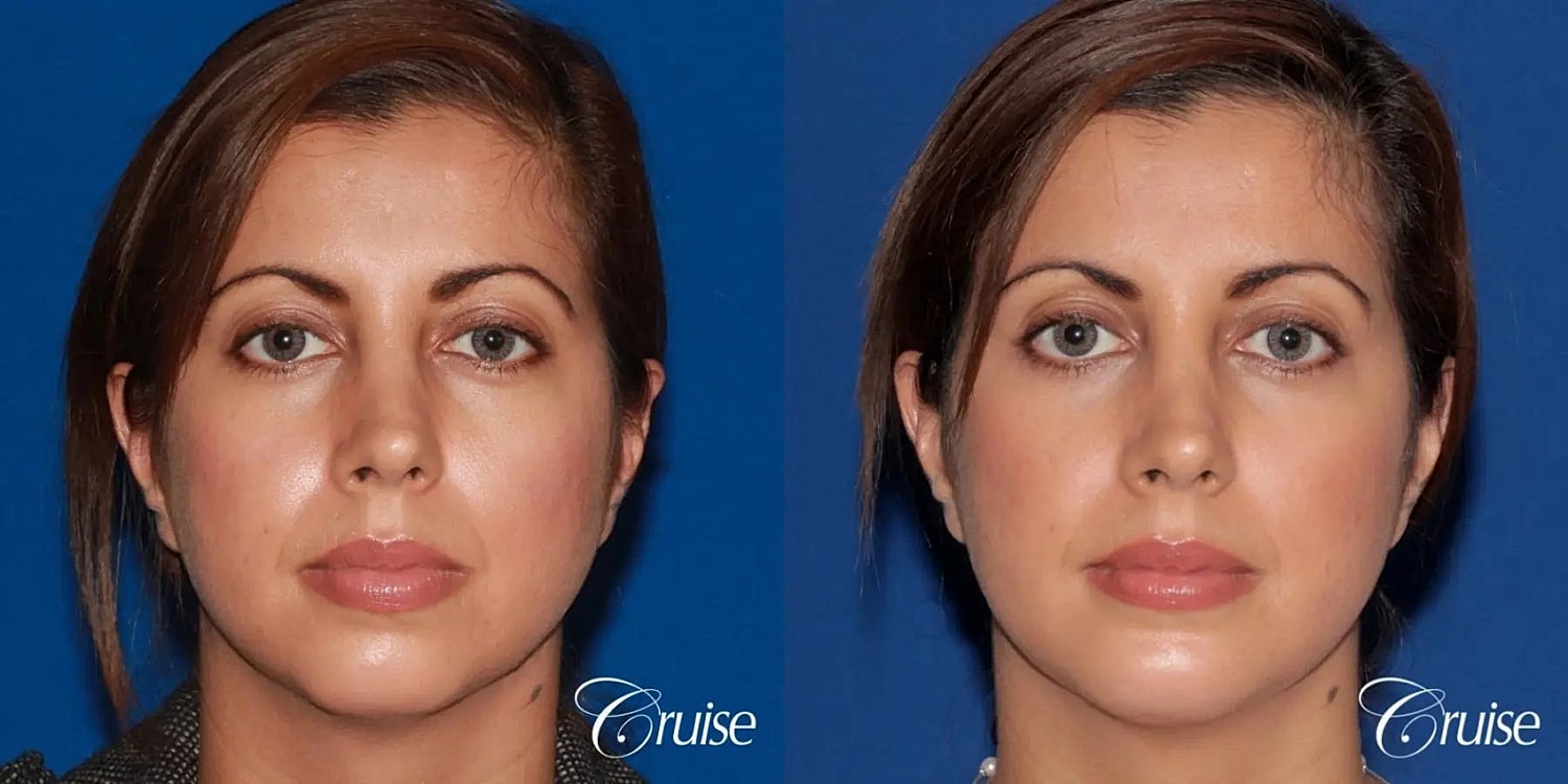 Chin Augmentation Before & After