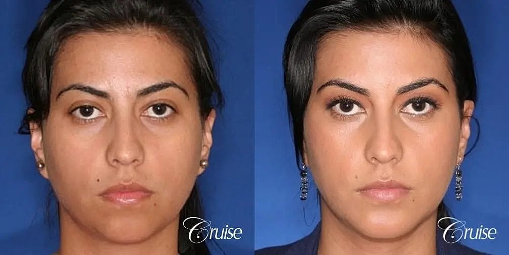 Chin Augmentation Before & After