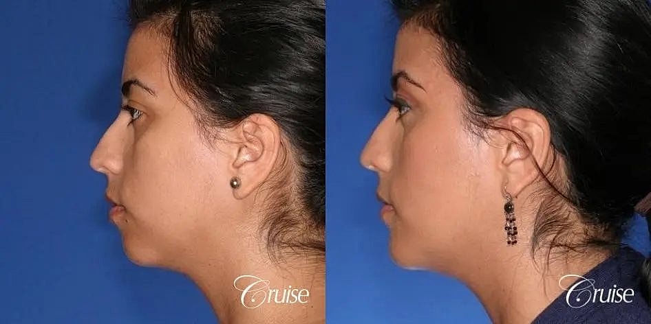 Chin Augmentation Before & After
