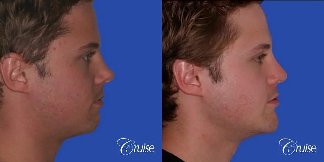 Chin Augmentation Before & After