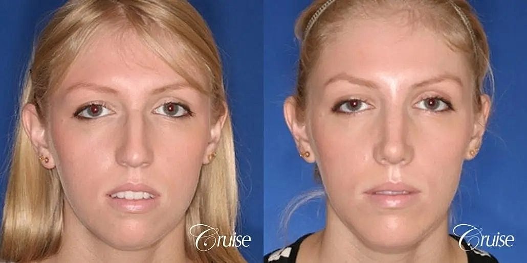 Chin Augmentation Before & After