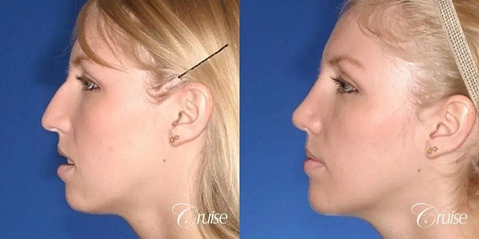 Chin Augmentation Before & After