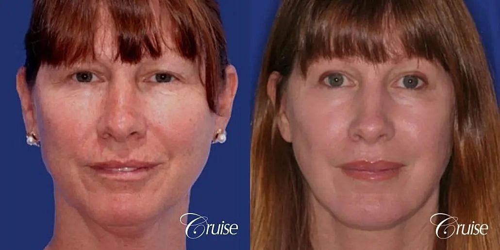 Chin Augmentation Before & After