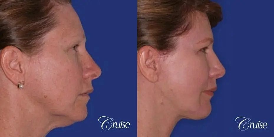 Chin Augmentation Before & After