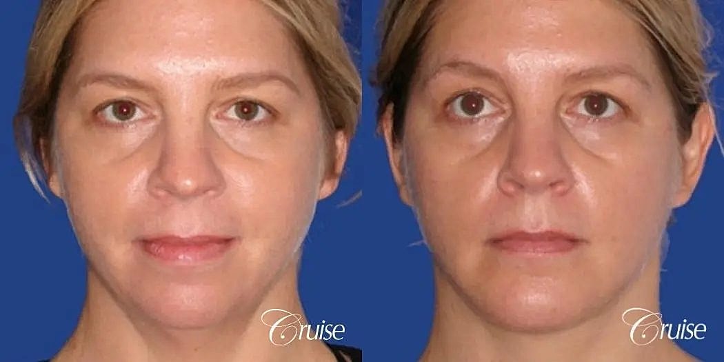 Chin Augmentation Before & After