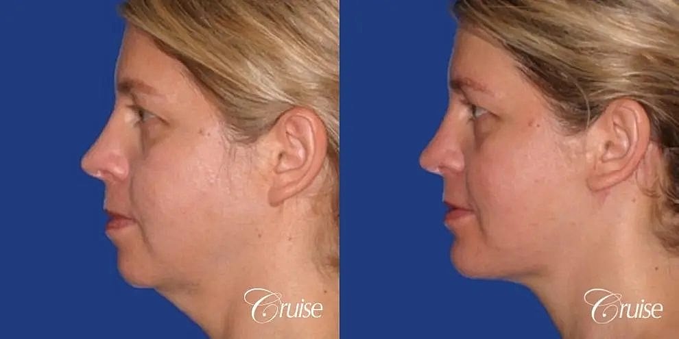 Chin Augmentation Before & After