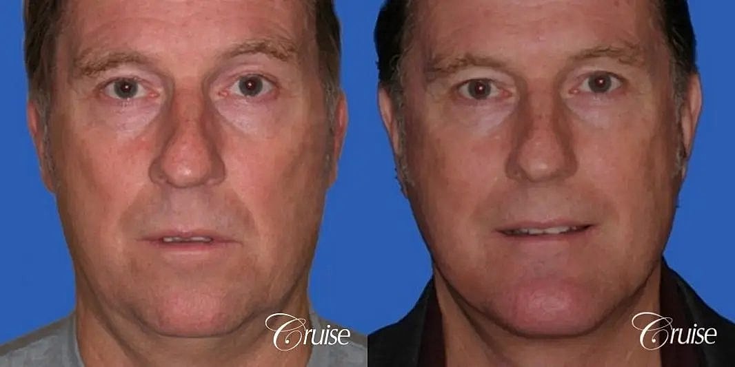 Chin Augmentation Before & After