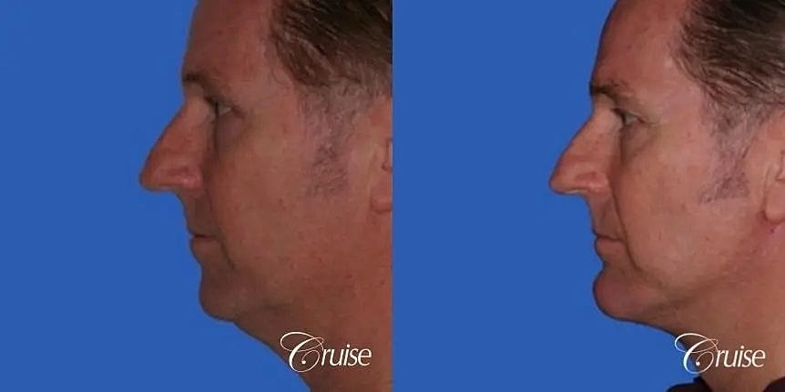 Chin Augmentation Before & After