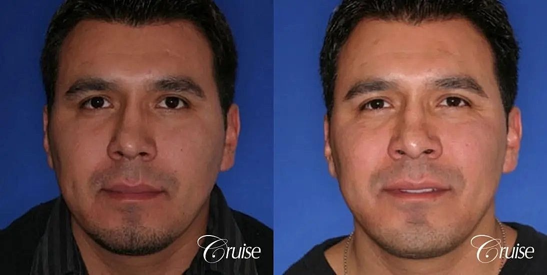 Chin Augmentation Before & After