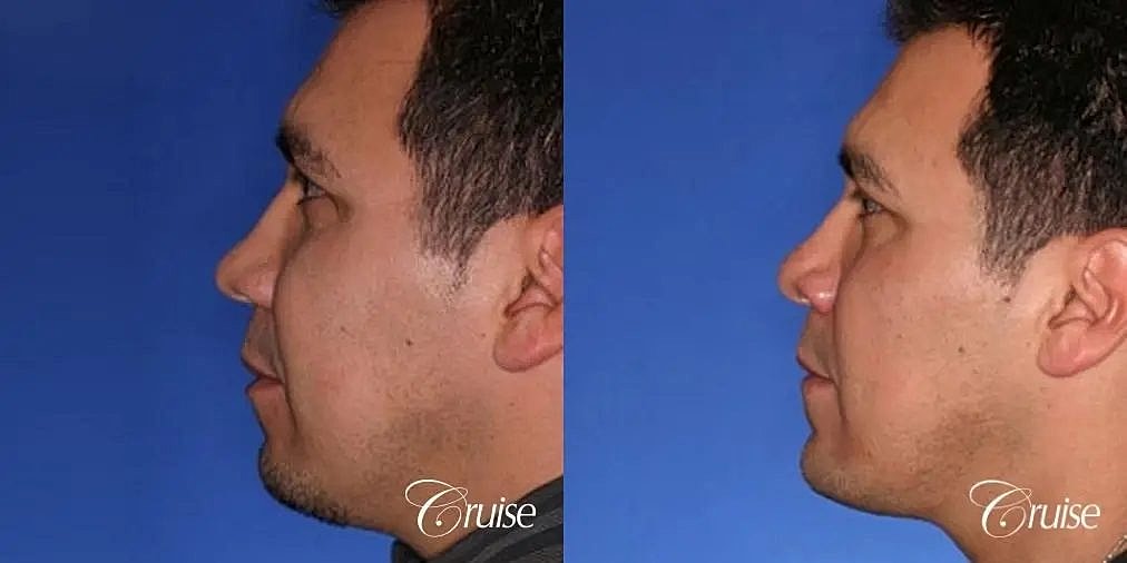Chin Augmentation Before & After