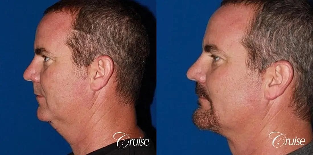 Chin Augmentation Before & After