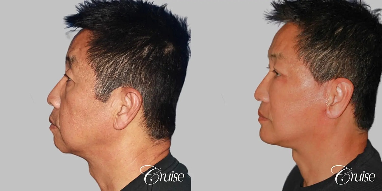 Chin Augmentation Before & After