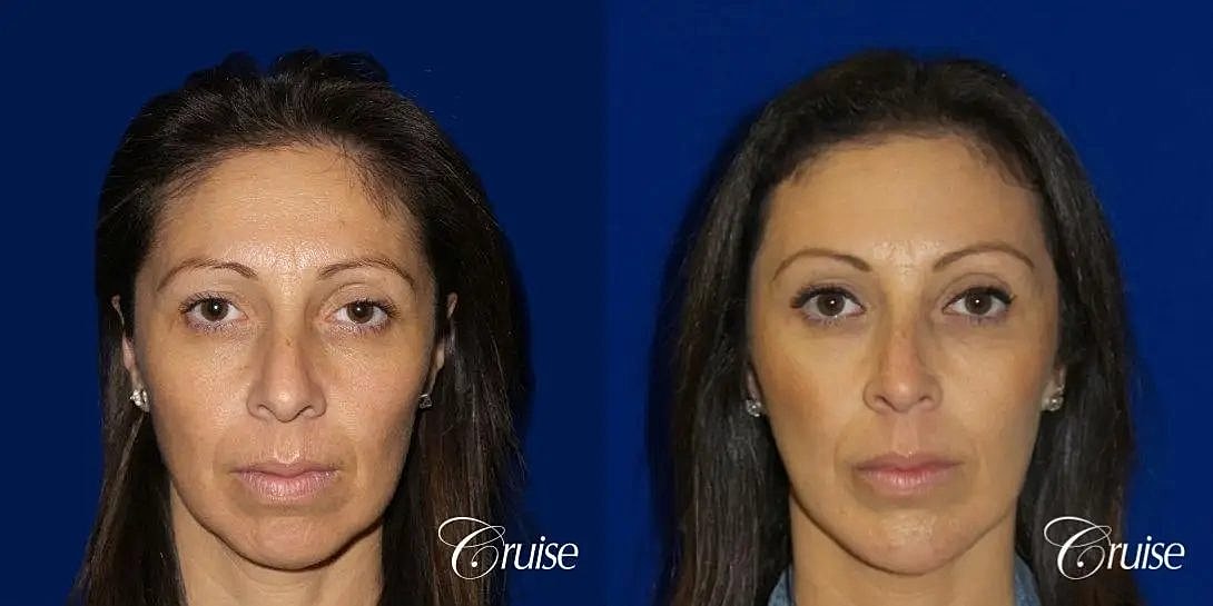 Brow Lift Before & After