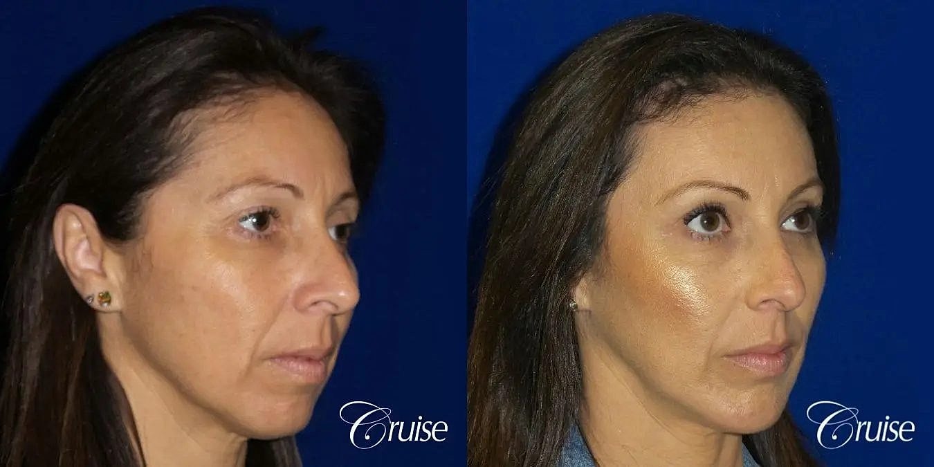 Brow Lift Before & After