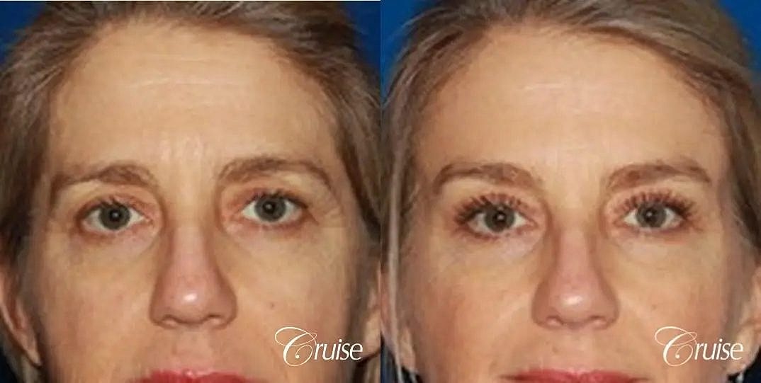 Brow Lift Before & After