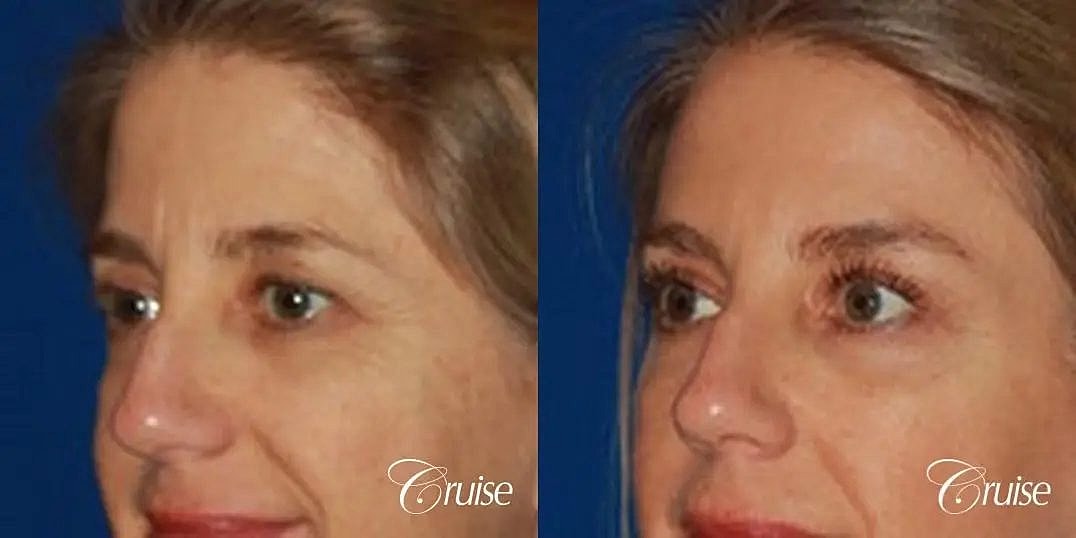 Brow Lift Before & After