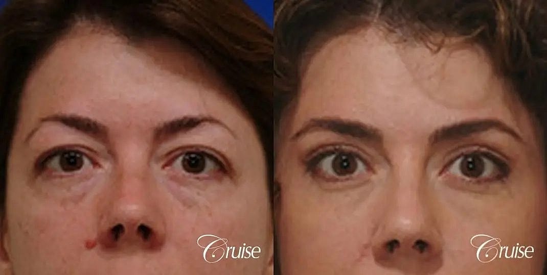 Brow Lift Before & After
