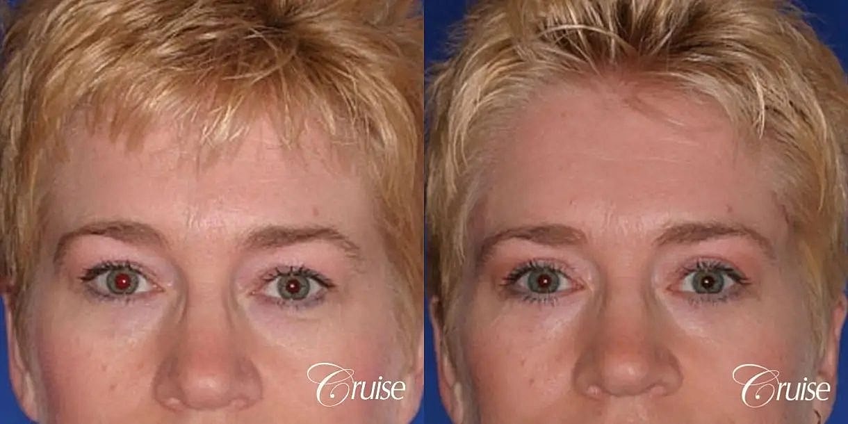 Brow Lift Before & After