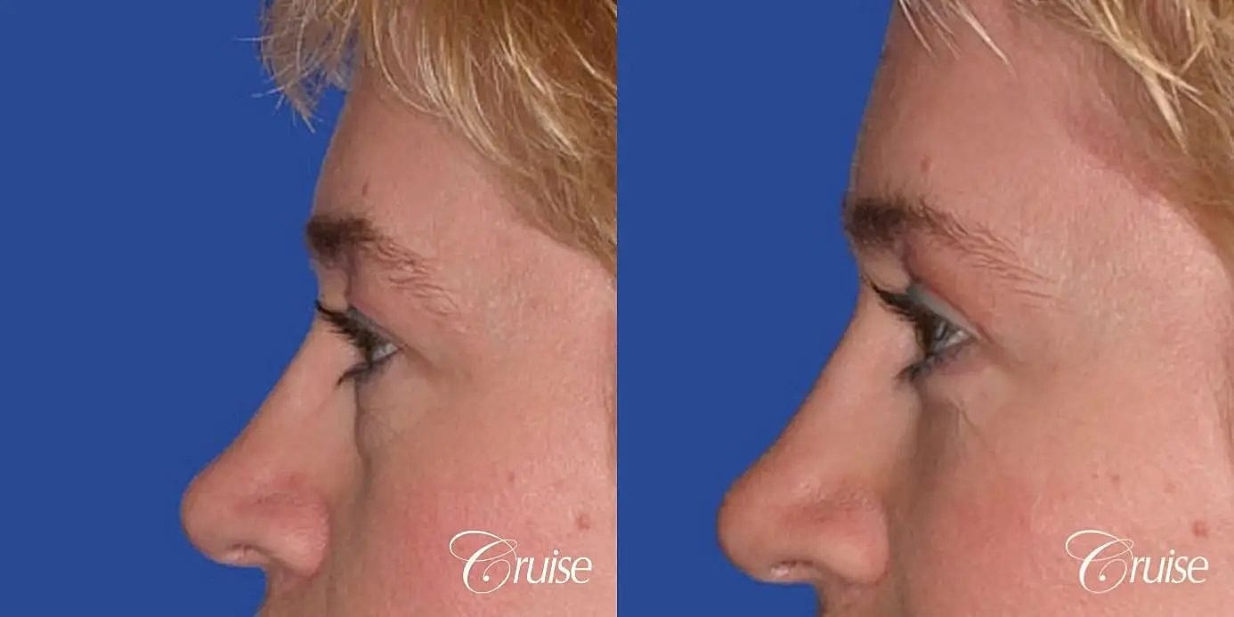 Brow Lift Before & After