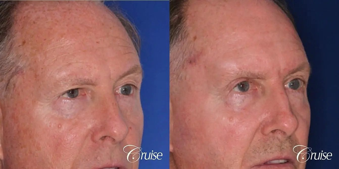 Brow Lift Before & After