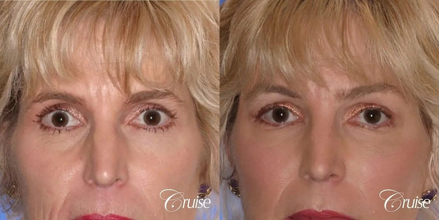 Brow Lift Before & After