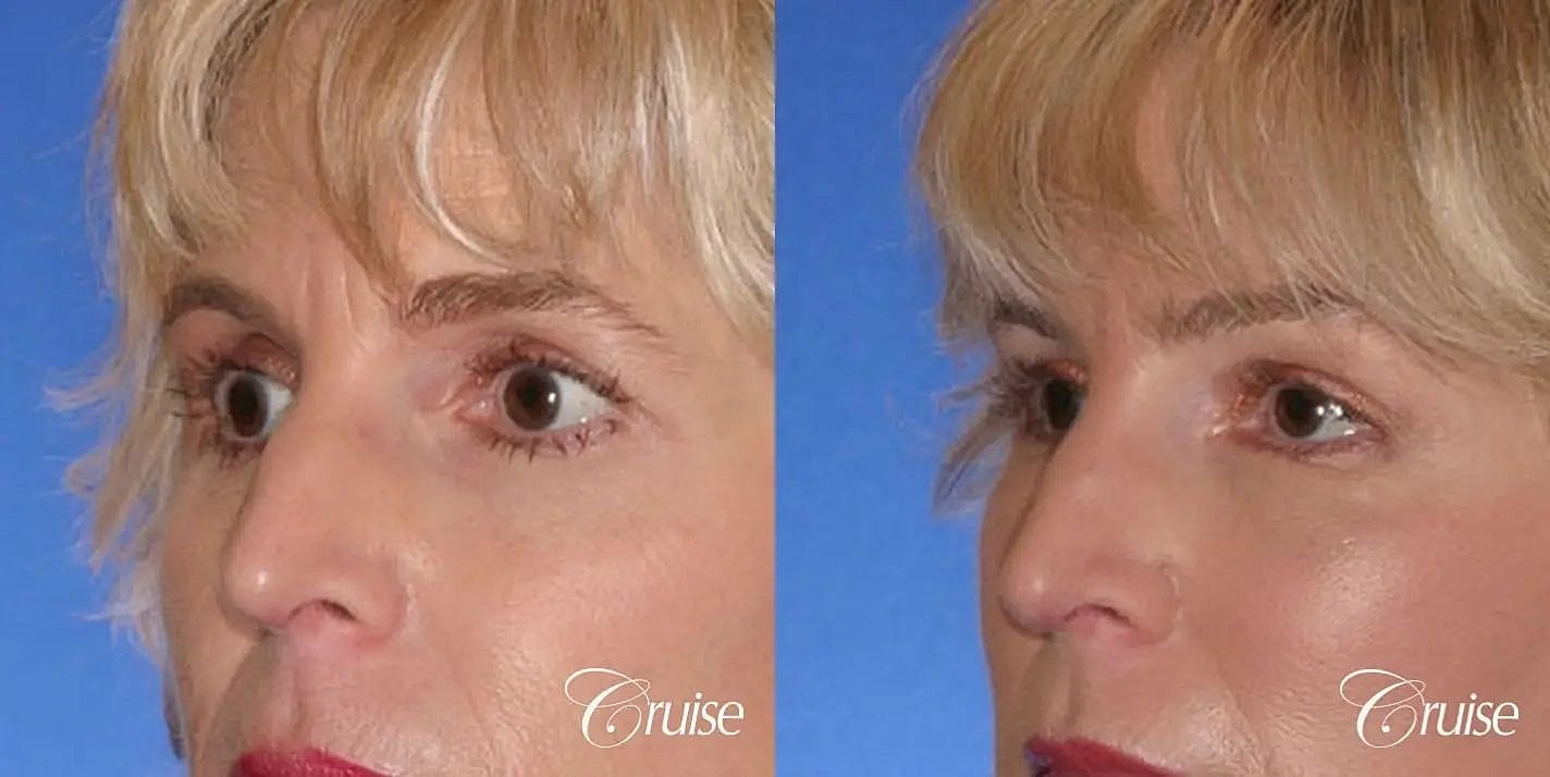 Brow Lift Before & After