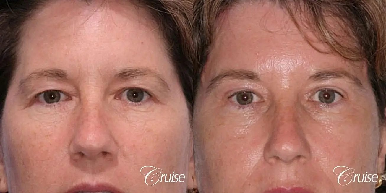 Brow Lift Before & After