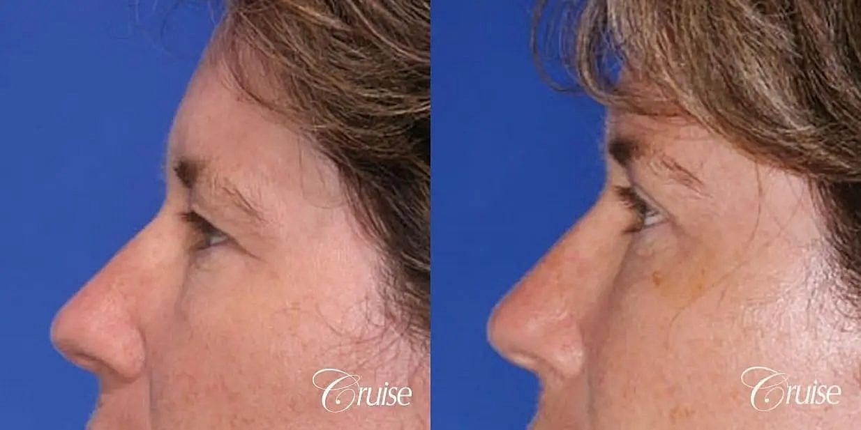 Brow Lift Before & After