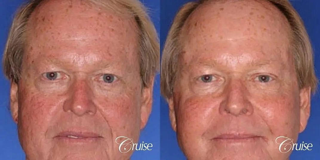 Brow Lift Before & After