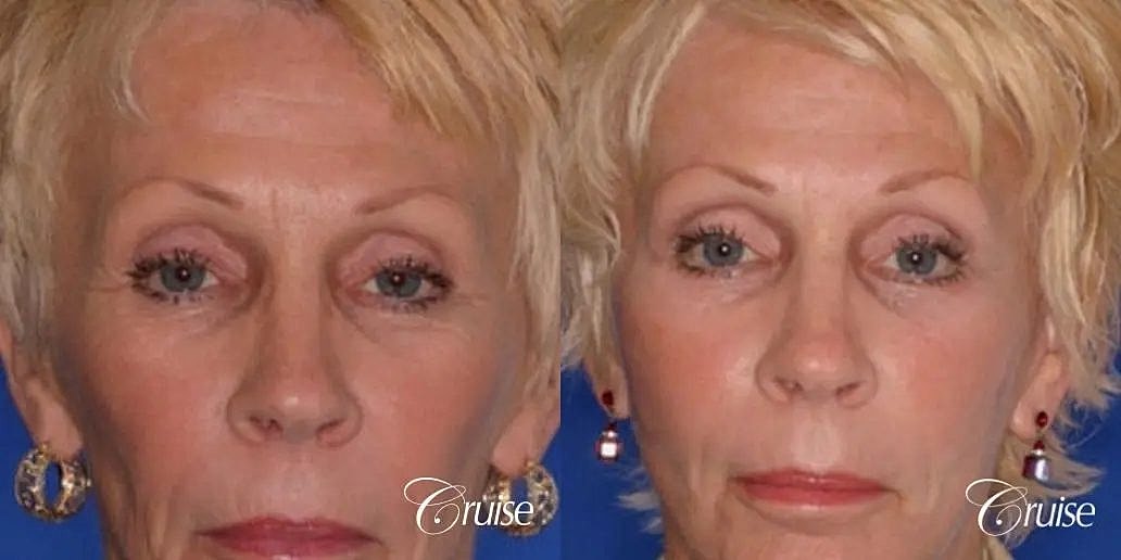 Brow Lift Before & After